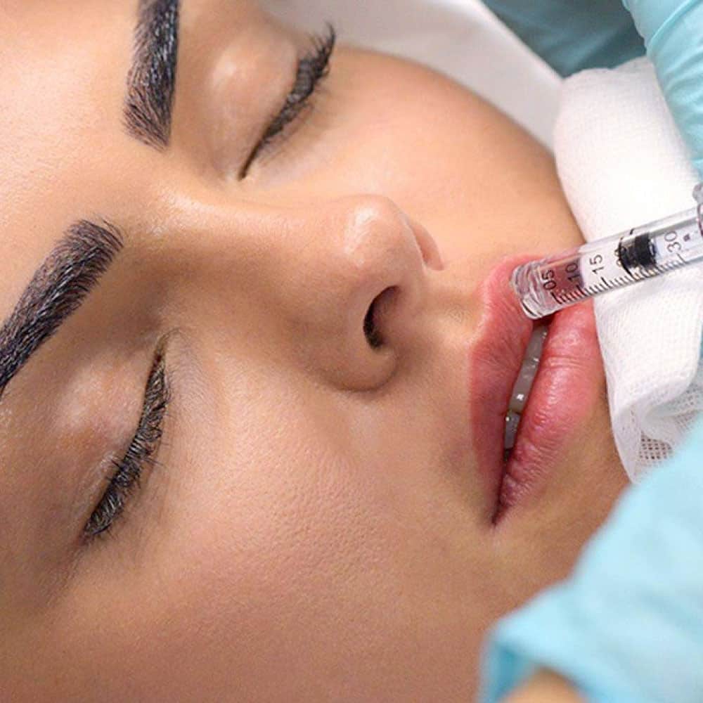 Filler labbra a Legnano