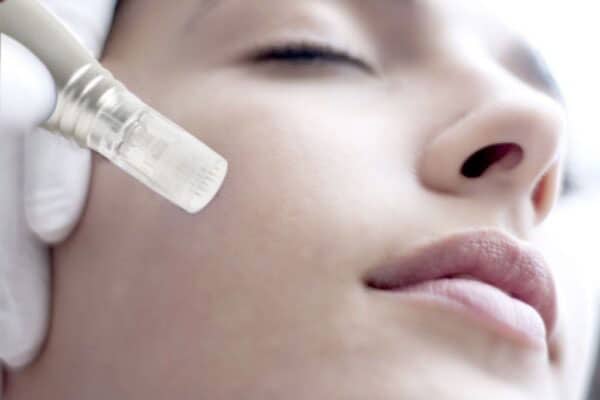 Microneedling Legnano
